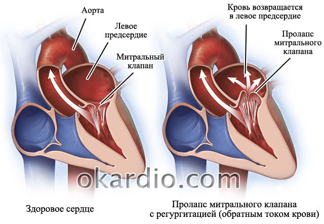 Фібриляція передсердь клініка діагностика лікування.  Класифікація фібриляції передсердь та форми миготливої ​​арит