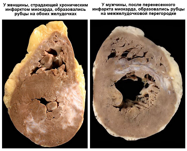 Постинфарктный кардиосклероз что это такое, симптомы и лечение, виды