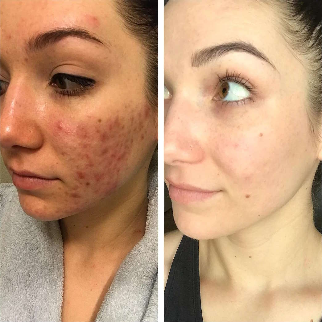 Spironolactone Uses, Side Effects, a Comprehensive Guide