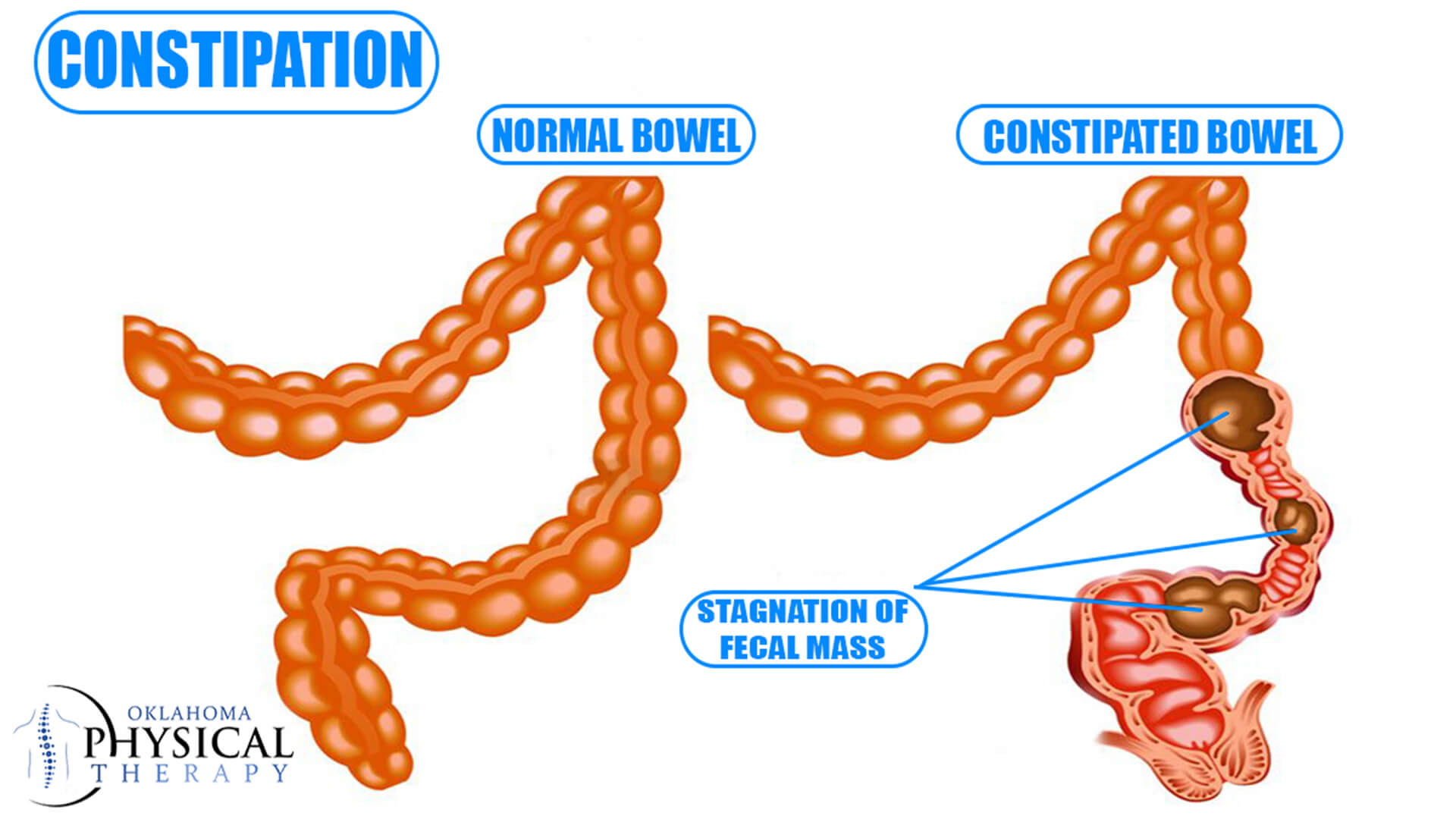 How Efficiently Can You Recover the Issue of Constipation by Pelvic