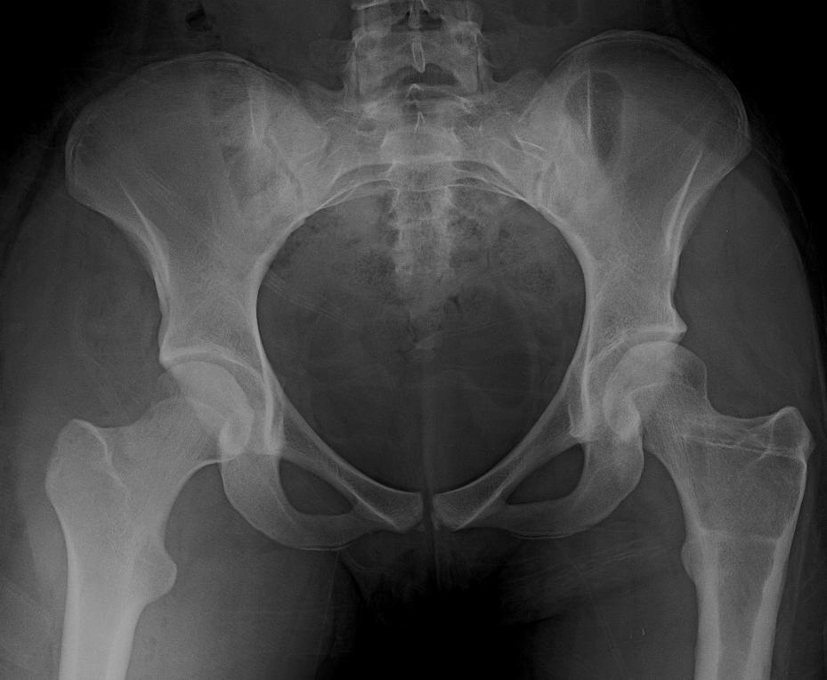 Proximal femoral osteotomy and hip arthroscopy to treat mild hip