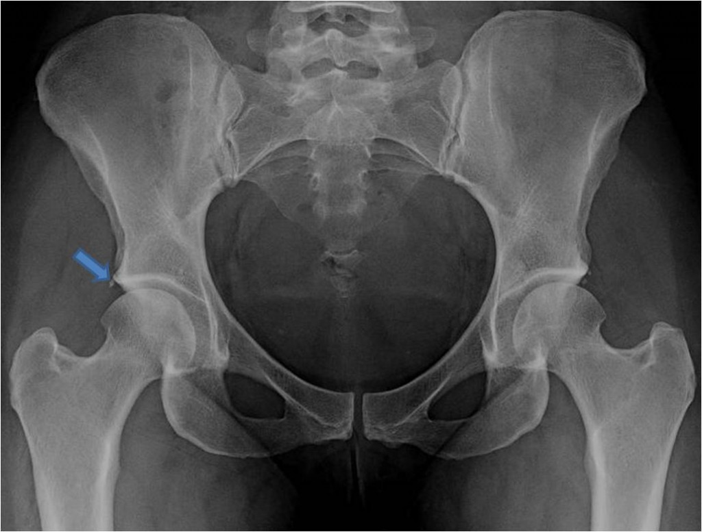 Hip arthroscopy to treat FAI in a female dance instructor St. Louis