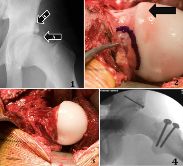 Open Hip Dislocation Surgery | St. Louis Hip Surgeon John C. Clohisy