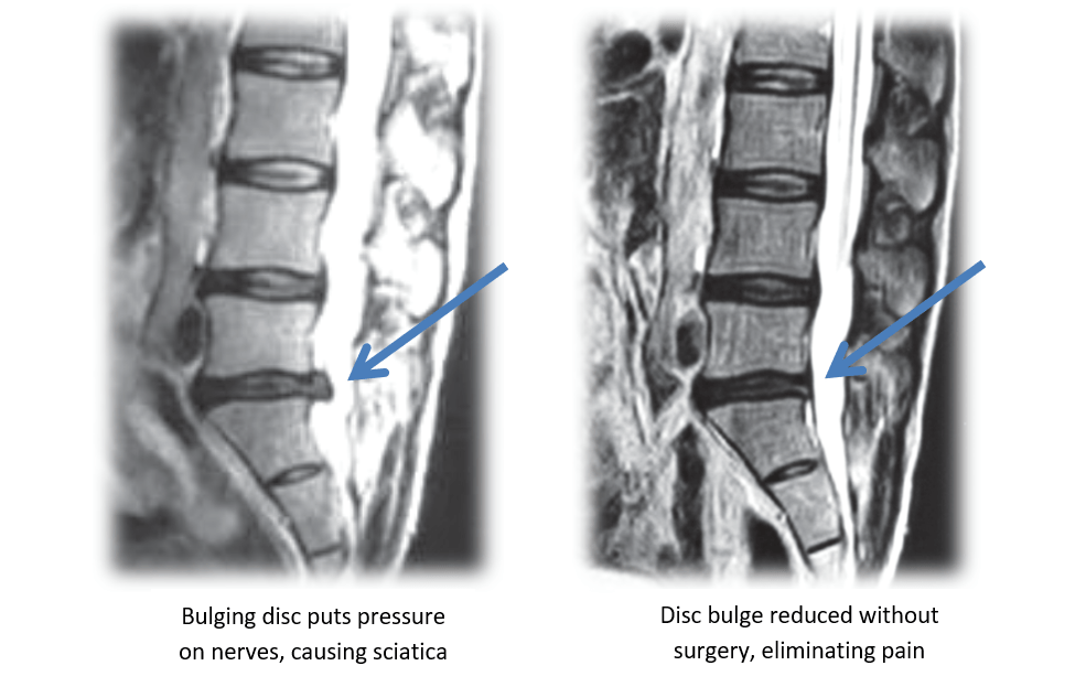Back Surgery vs. Nonsurgical Therapy For Spinal Relief