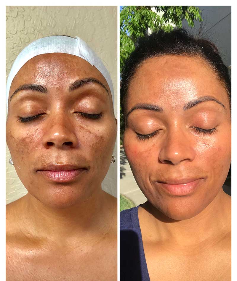 Micro Needling Omani Beauty and Wellness