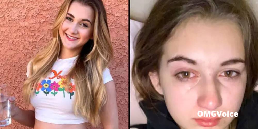 Meet The Girl Allergic To Water, Can't Cry Or Take A Shower