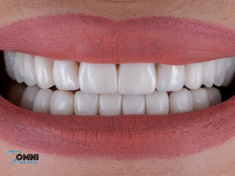 Can you whiten porcelain veneers? Omni Dental Arlington Heights, IL