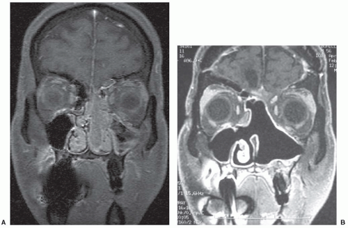 Cancer of the Nasal Vestibule, Nasal Cavity, Paranasal Sinuses ...