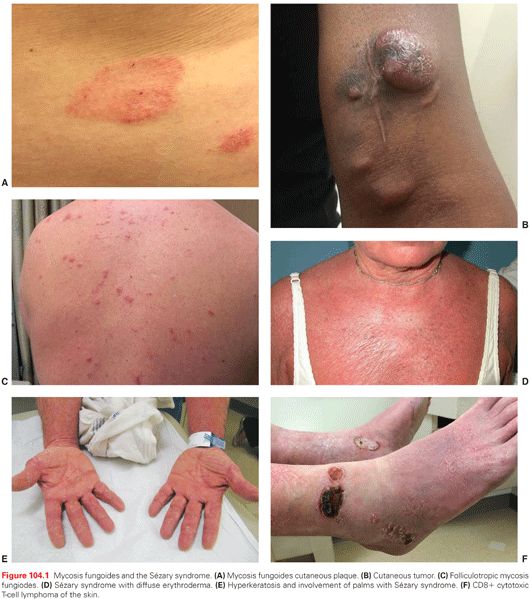 Icd10 Code For Lymphedema Vs Sebaceous Cyst