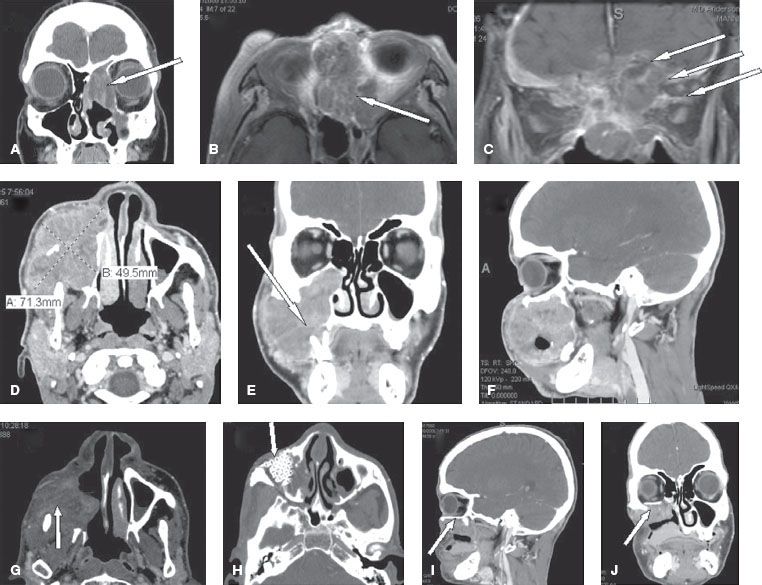 Cancer of the Nasal Cavity and Paranasal Sinuses Oncohema Key