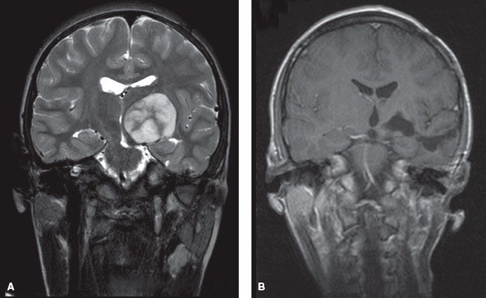 Central Nervous System Tumors in Children Oncohema Key