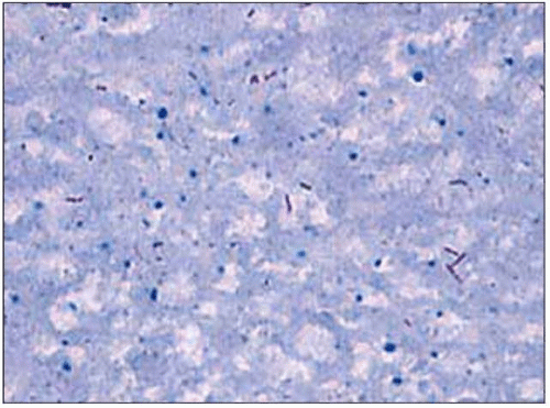 Tuberculosis Oncohema Key