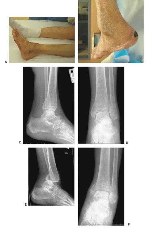 Icd 10 Code For Cellulitis Of Right Second Toe