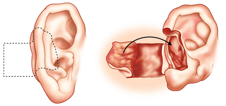 Skin Cancer of the Ear: Mastoid Interpolation Flap Reconstruction Tips ...