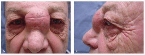 Cancer of the Nasal Cavity and the Paranasal Sinuses Oncohema Key