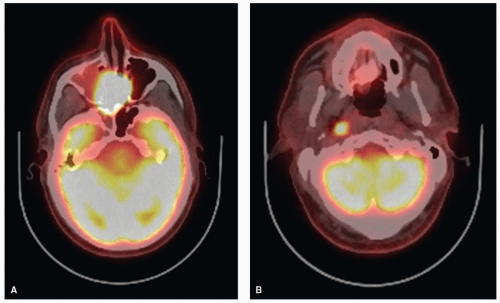 Cancer of the Nasal Cavity and the Paranasal Sinuses Oncohema Key