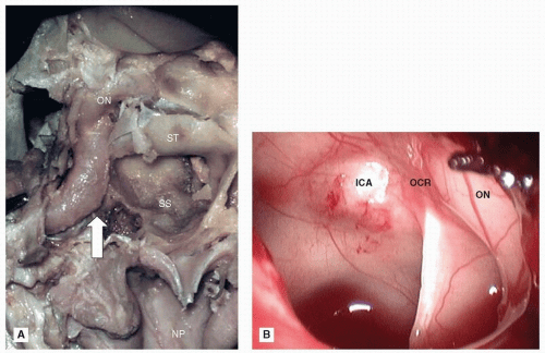 Cancer of the Nasal Cavity and the Paranasal Sinuses Oncohema Key