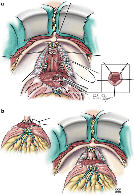 Simple Retropubic Prostatectomy Cpt Code – ZYYYKY