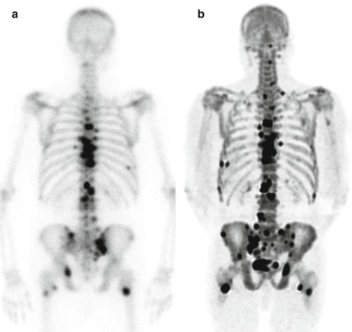 Nuclear Medicine Modalities To Image Bone Metastases With Bone Targeting Agents Conventional Scintigraphy And Positron Emission Tomography Oncohema Key