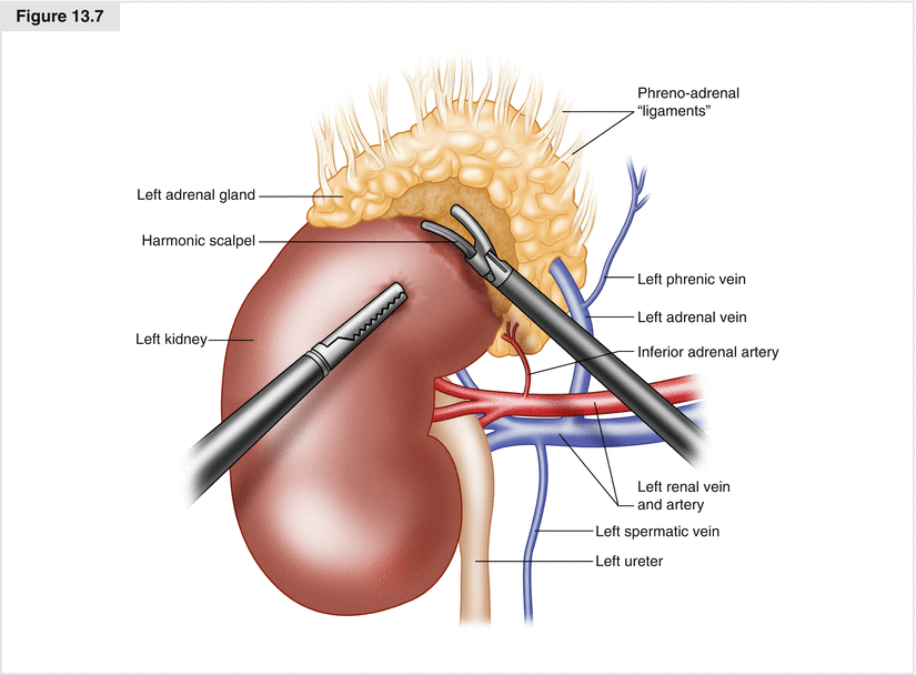 Posterior Retroperitoneoscopic Adrenalectomy Oncohema Key