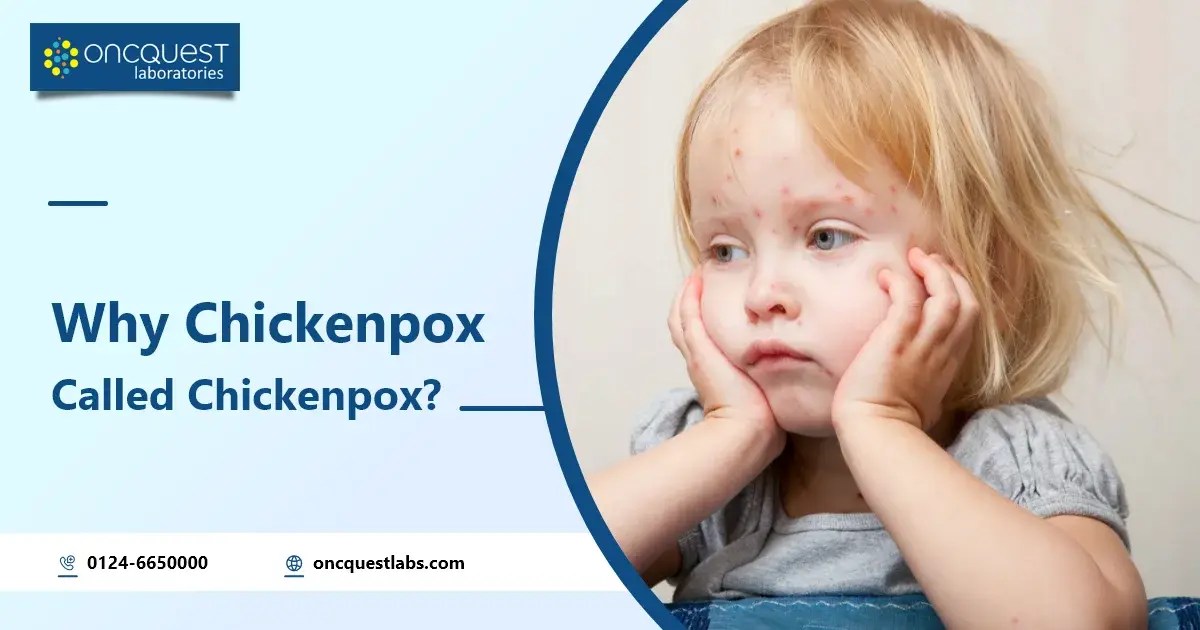 Why Chickenpox is Called Chickenpox Oncquest Blog Your Health Guide