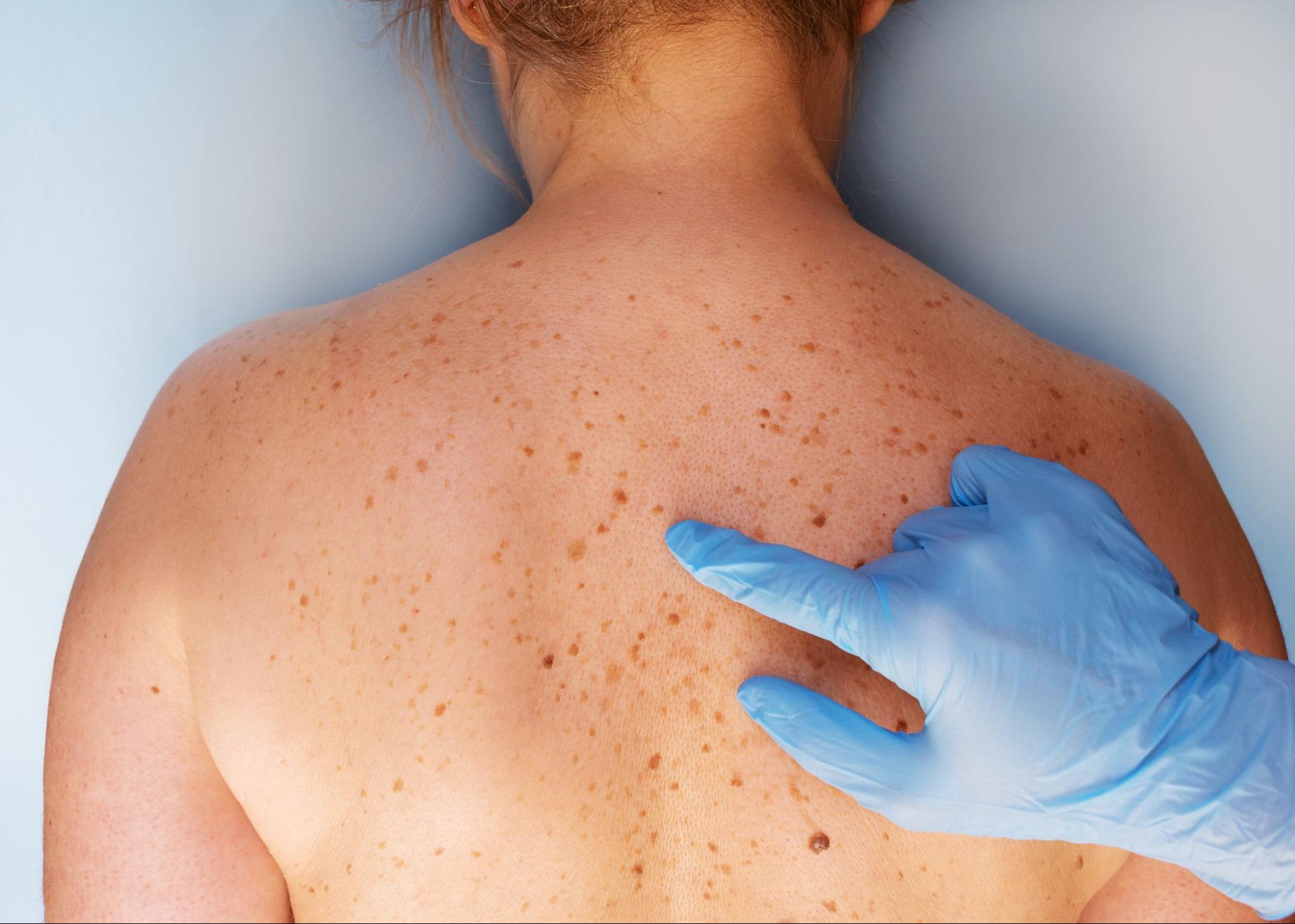 Top 5 Reasons to Get a Skin Cancer Check O'Neill Plastic Surgery