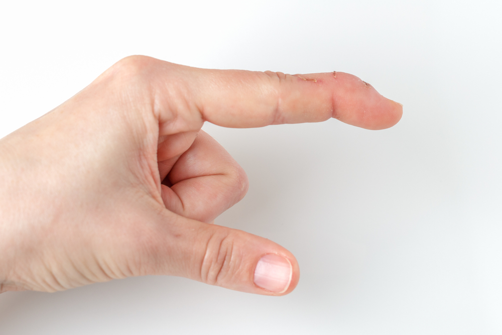 Treatments For Finger Deformity Hand And Wrist Conditions