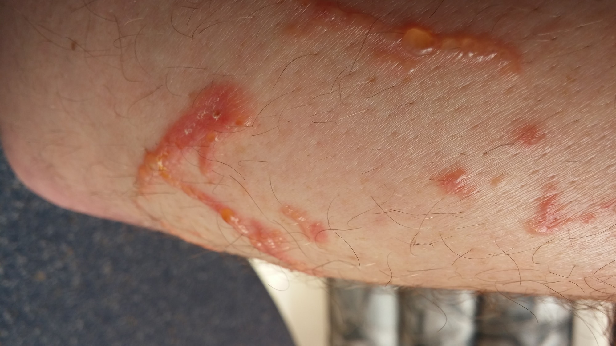 Dan's Man Rants Poison Ivy (he Dan)