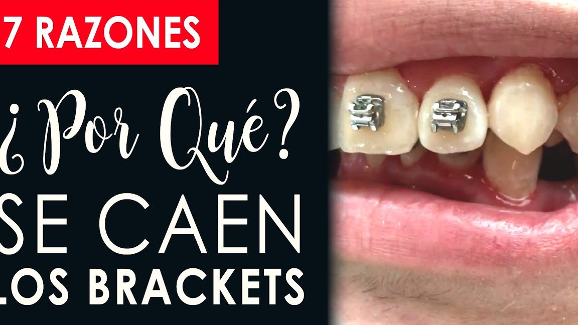 ¿Qué significa soñar que se te caen los brackets? Descubre su