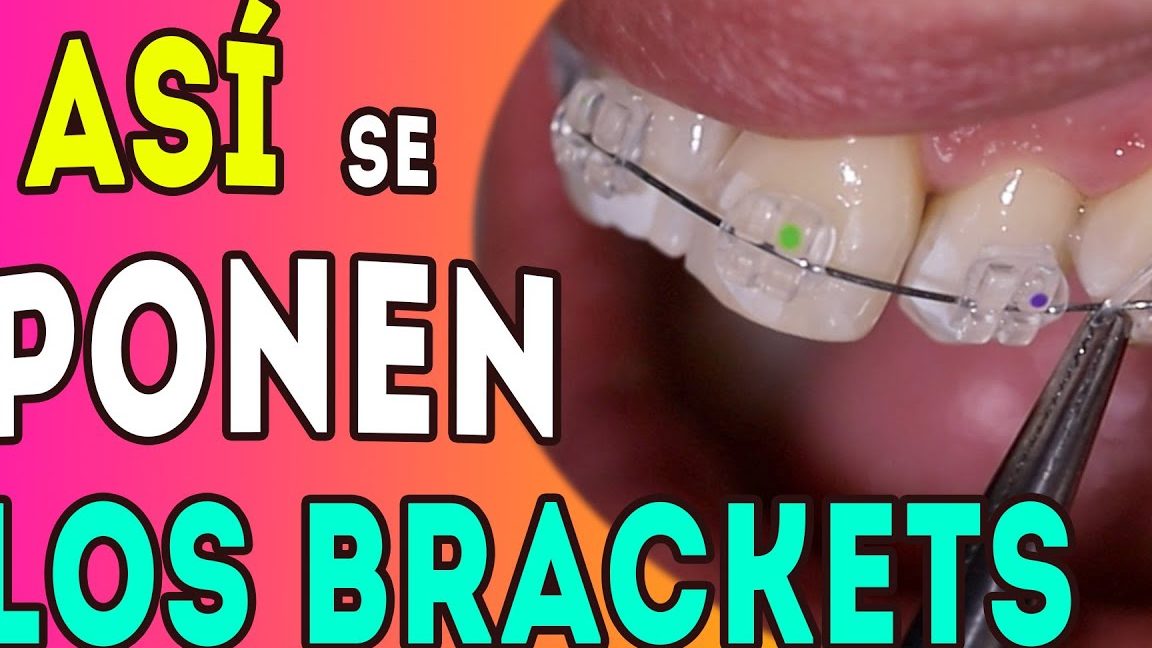 ¿Qué significa soñar con brackets? Descubre el significado de los