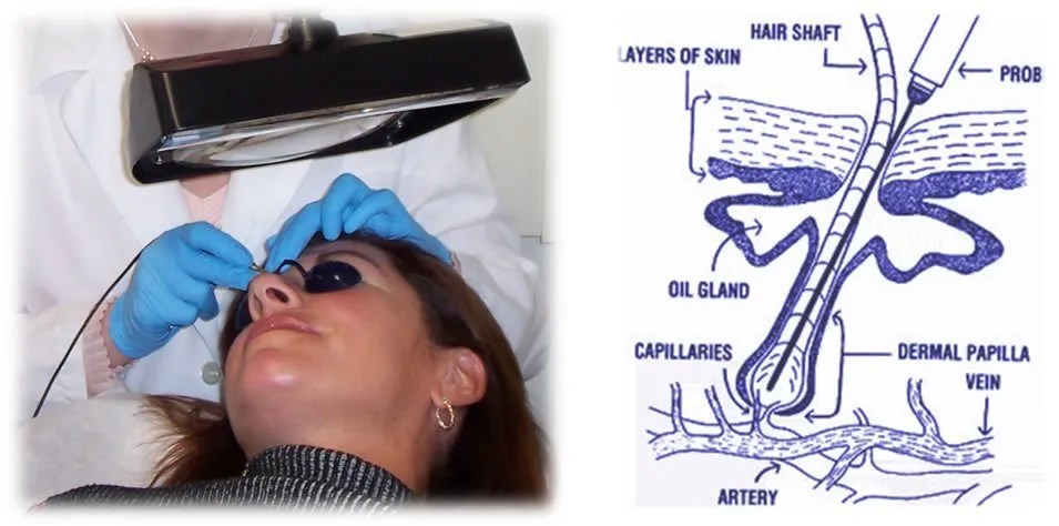 Electrology Program FMAIS Online Courses In Miami.