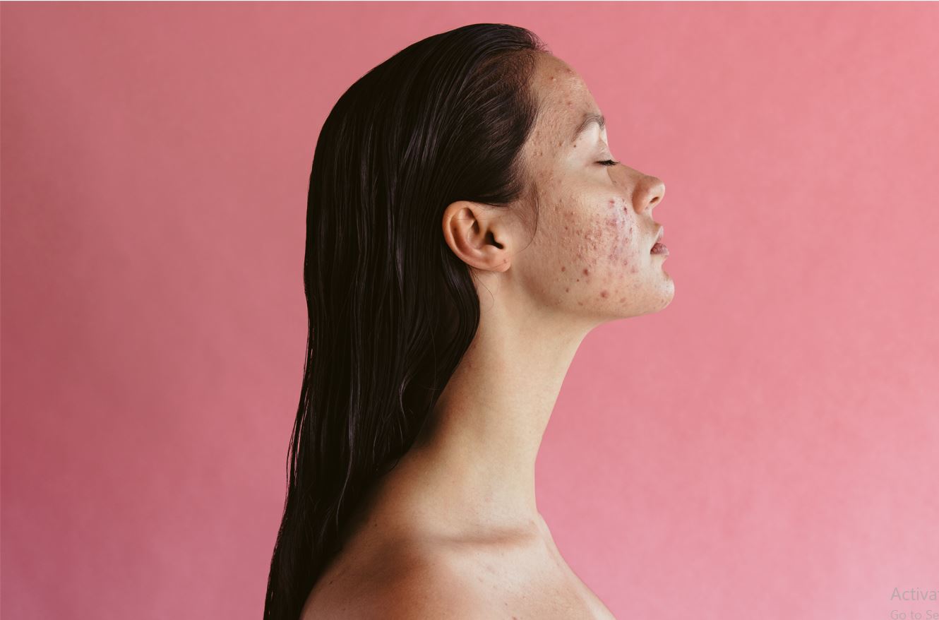 11 Expert Tips For AcneProne Skin