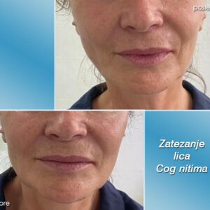 Podizanje lica i zatezanje vrata COG nitima