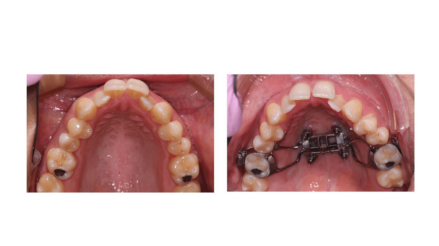 Bottom Palate Expander