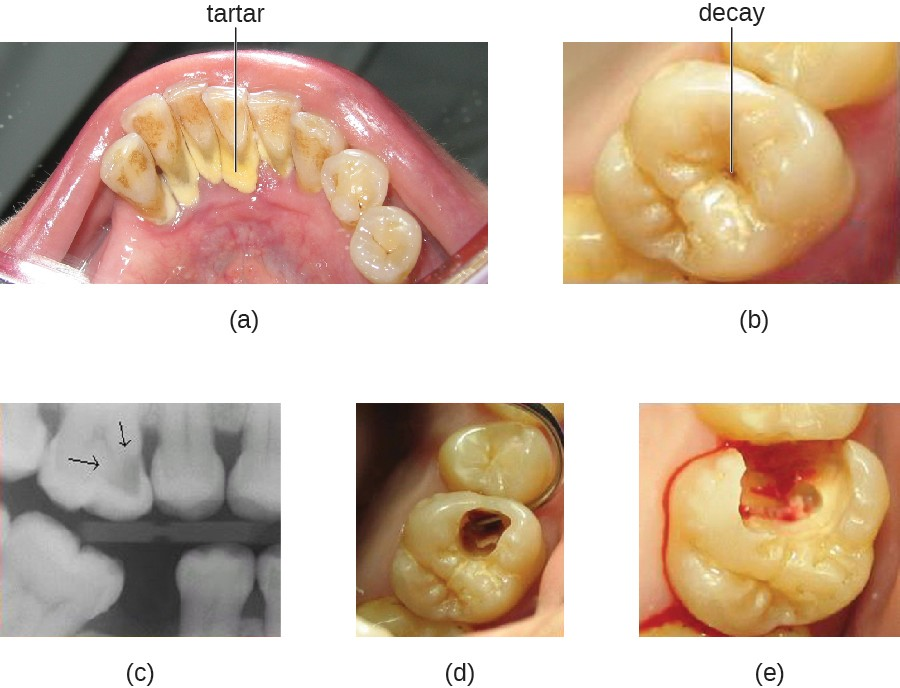 19.2 Microbial Diseases of the Mouth and Oral Cavity Allied Health