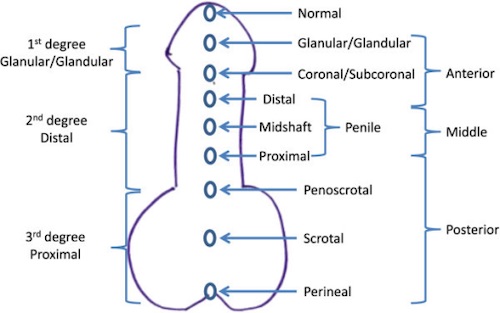Epispadias Vs Hypospadias