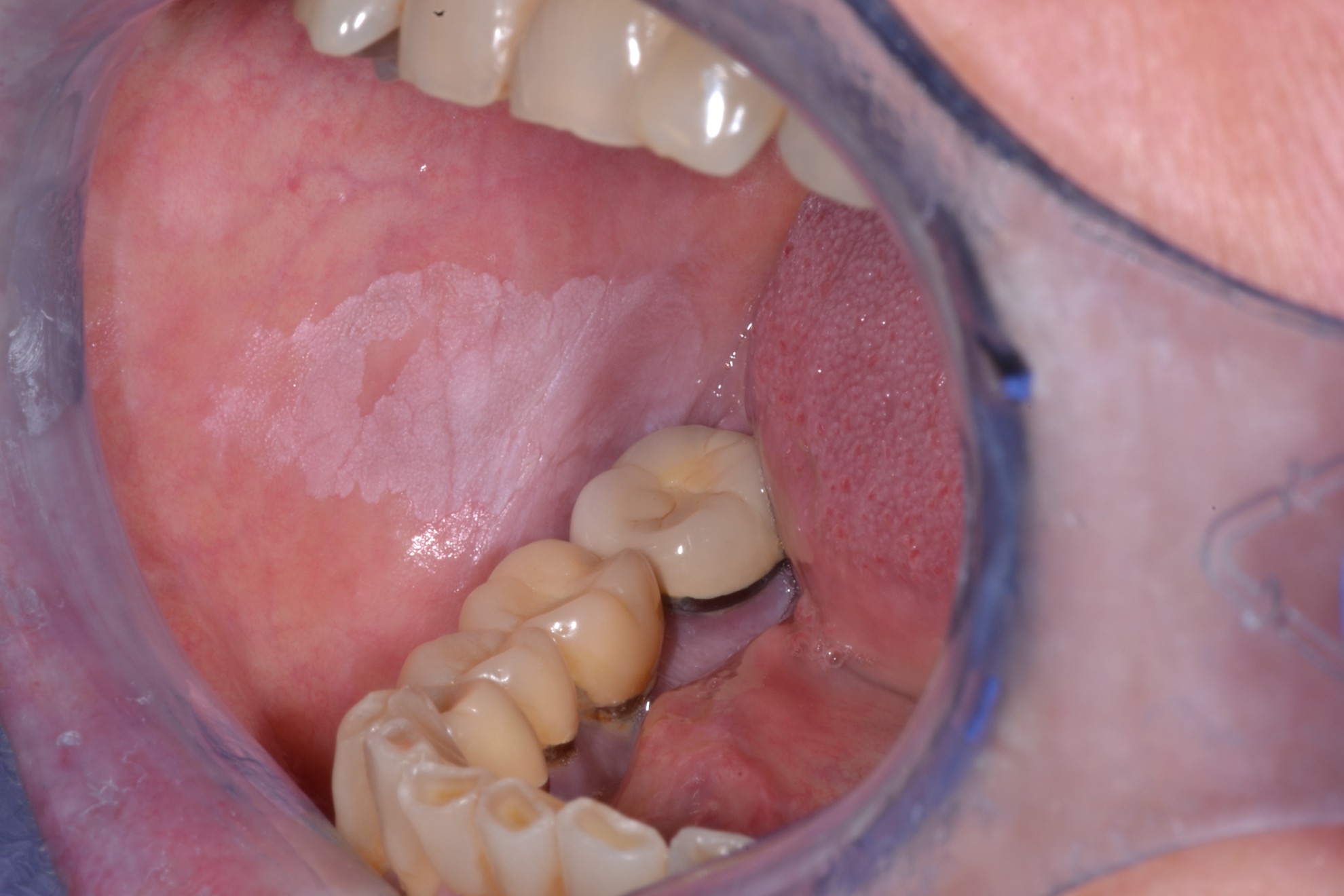 Oral Leukoplakia OPMDCARE