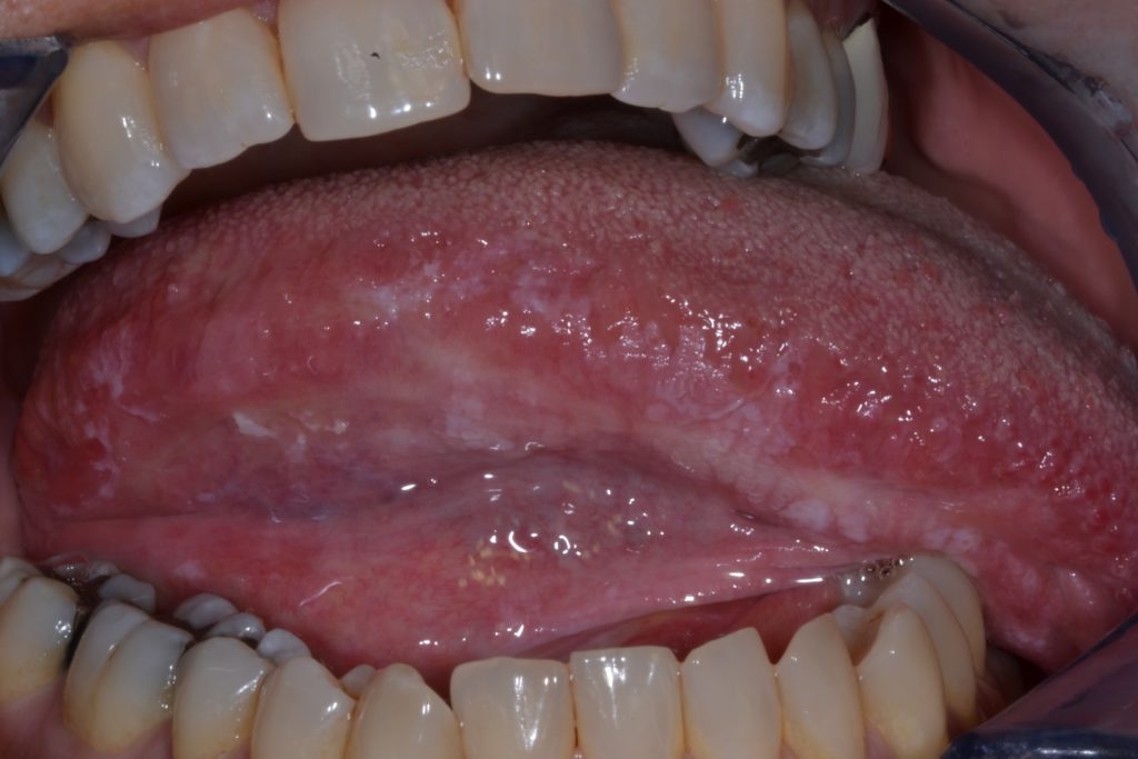 Oral Leukoplakia OPMDCARE