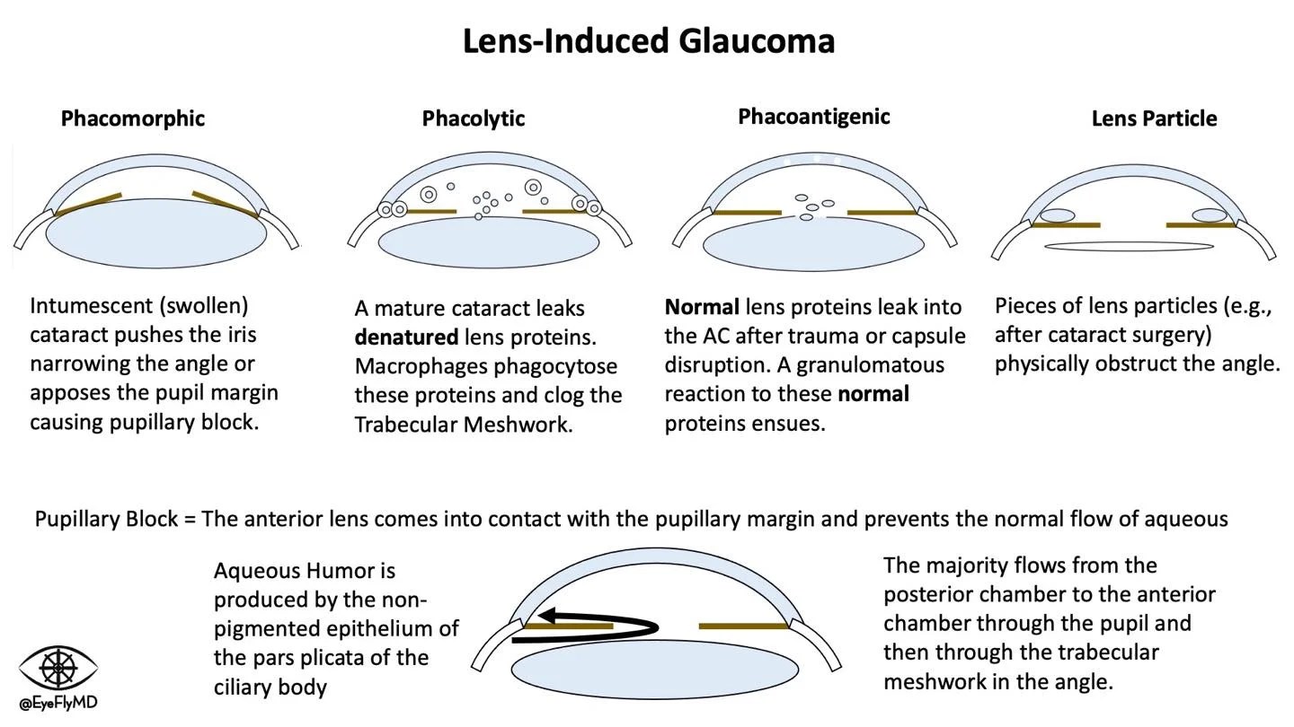 5 types of Lens induced An Eye Care Blog