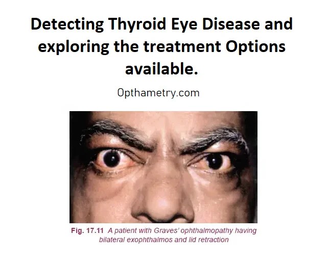 Detecting Thyroid Eye Disease and treatment options of Graves