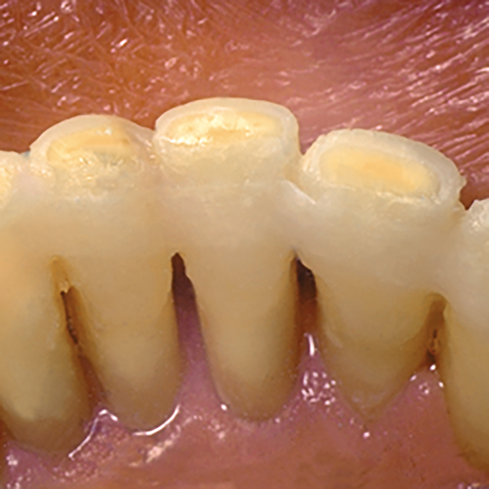 Ribbond Ultra Starter Kit Optident