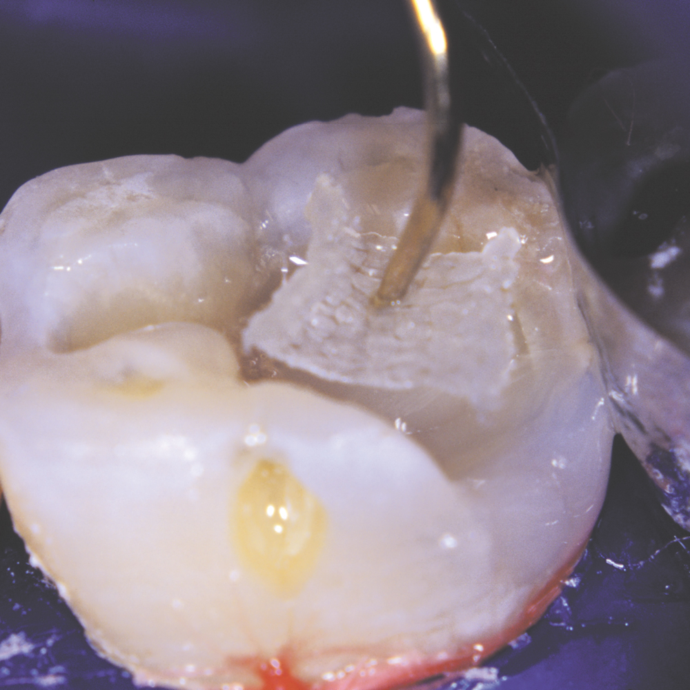 Ribbond Ultra Refill 3mm Optident