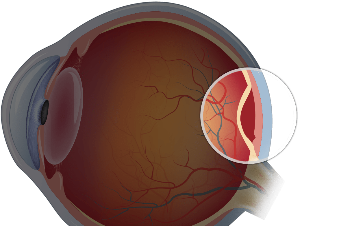Ablacija retine Uzroci, Simptomi, Dijagnostikovanje, Lečenje, Prevencija