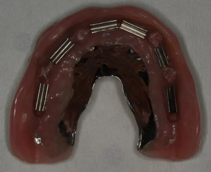 Dental Implants Optima Dental Care