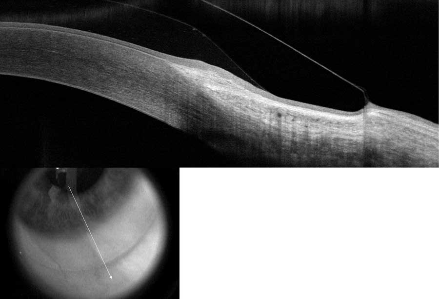 The Ultimate Guide to Scleral Lenses 2019 Best of Nashville Optometrist