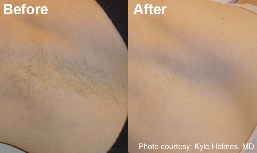 Laser Hair Removal Optiskin