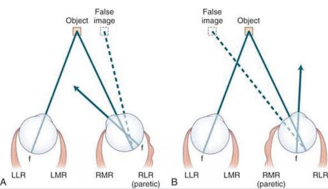 Diplopia (Double Vision) Physiological and pathological Optography