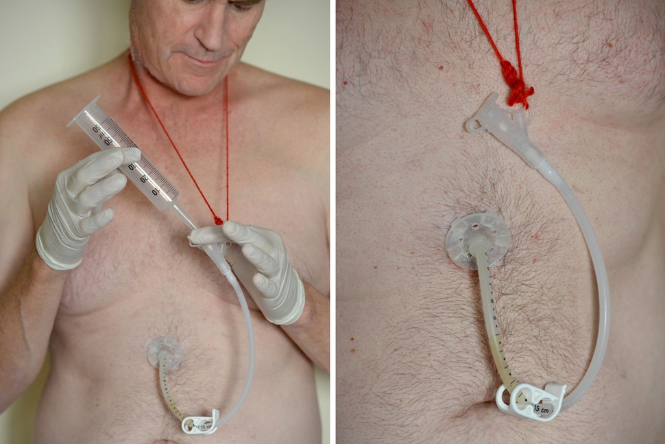 Living well with a feeding tube Oral Cancer News