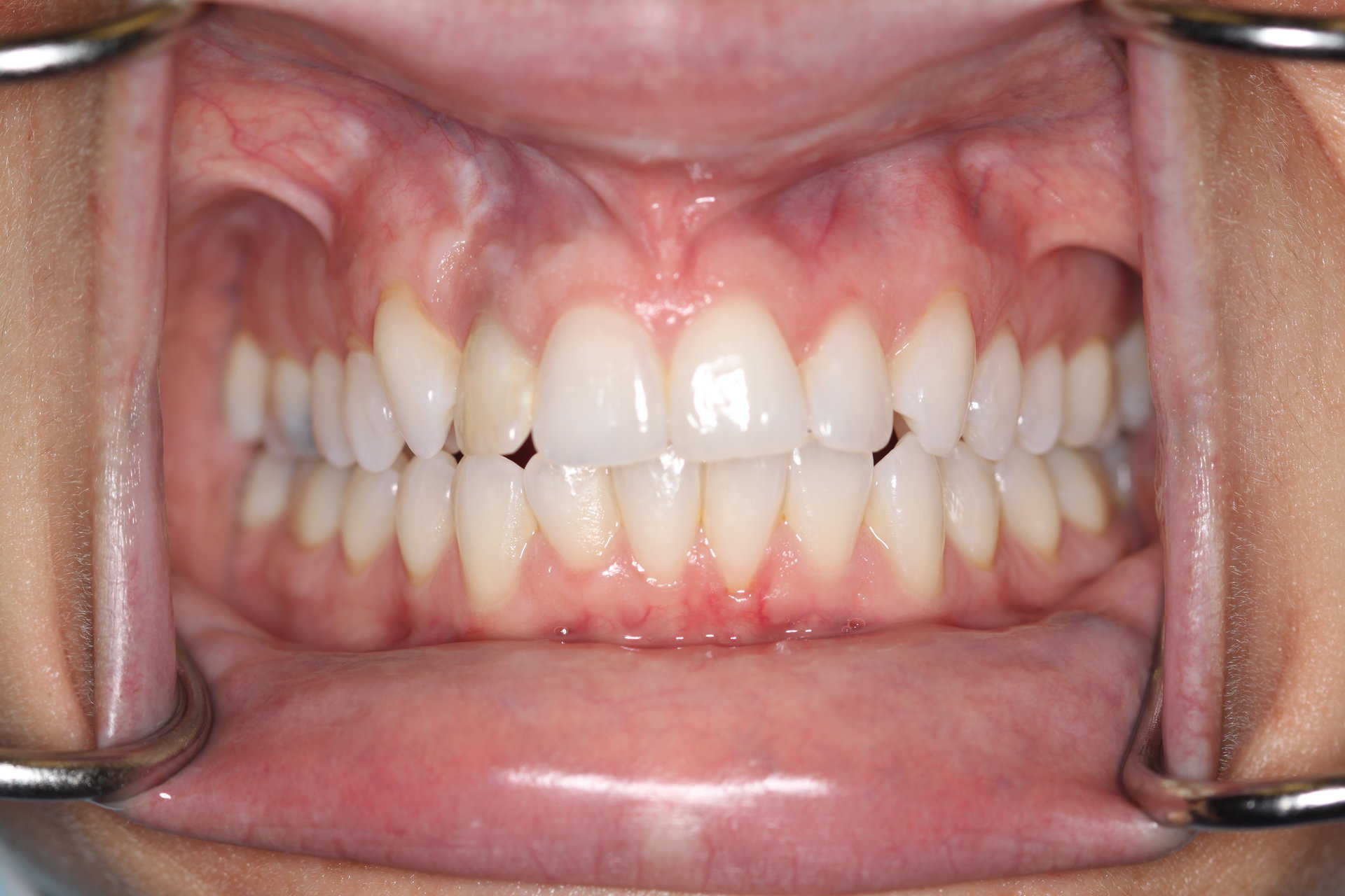 Can Wisdom Teeth Shift Your Teeth? Oral Facial Surgical Arts, PA