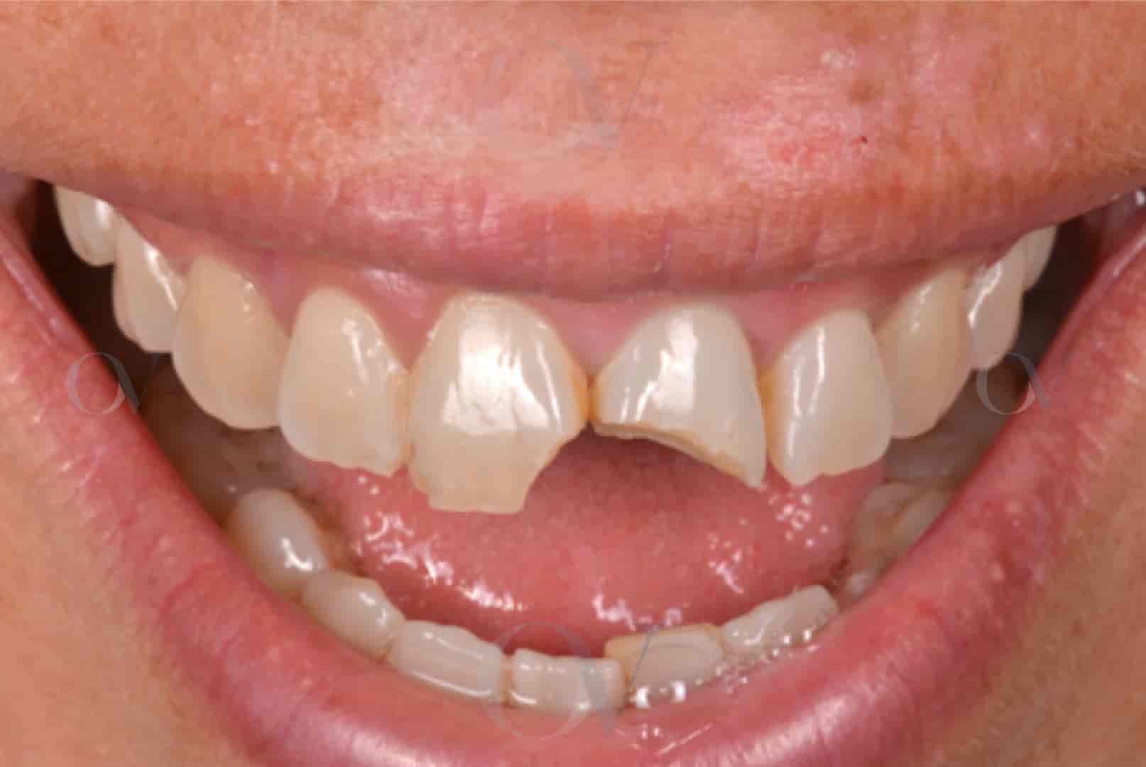 ᐈ Desgaste Dental abrasión, atrición, erosión y abfracción 🥇🥇